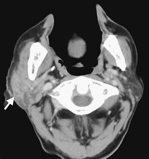 Acute Parotitis After Double Balloon Endoscopy Gastrointestinal Endoscopy