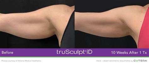 Trusculpt Id Fat Reduction Book Free Consultation Online See Pictures