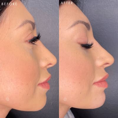 Las Vegas Aesthetic Facial Fillers Sculpt Spa