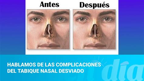 Hablamos De Las Complicaciones Del Tabique Nasal Desviado Youtube