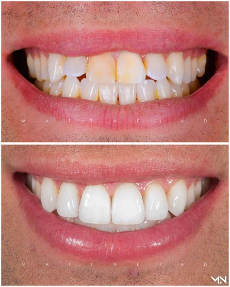 Cosmetic Smile Makeover With Porcelain Veneers To Correct Flared