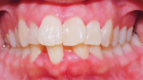 Class Iii Malocclusion Deep Overbite Severe Lower Crowding Narrow