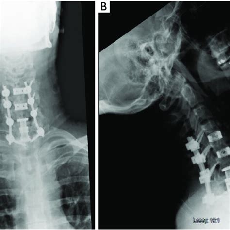 Ap A And Lateral B Postoperative Cervical Spine Radiographs