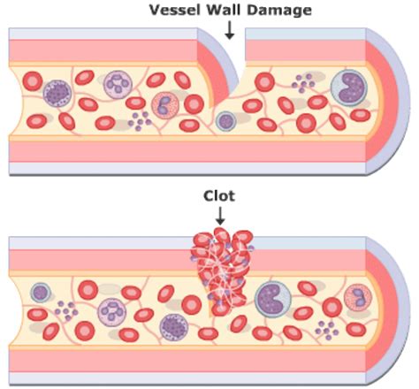 Causes Of Blood Clotting Quickly At Hester Cooper Blog