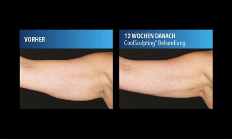 Coolsculpting Kryolipolyse M Nster Fettreduktion Ohne Op Dr R Tter