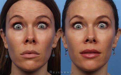 How To Get Natural Results With Botox Video Rejuvent Medical Spa