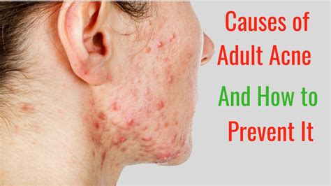 5 Causes Of Adult Acne And How To Prevent It Youtube