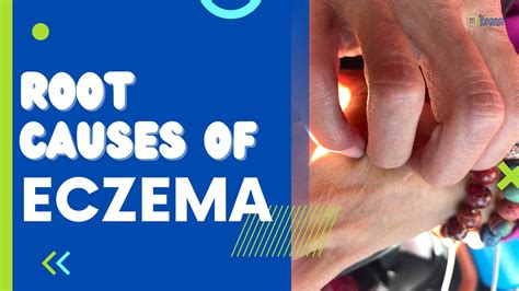 Root causes of eczema - The Movement Paradigm