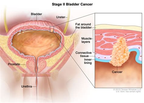 Bladder Cancer Stages Nci