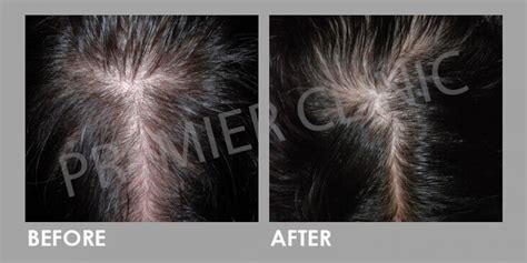 Mesotherapy For Hair Loss Premier Clinic