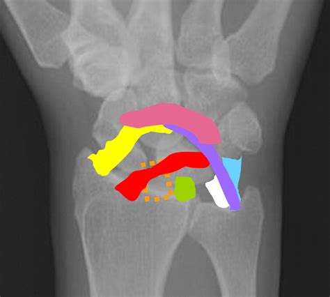 US Of The Intrinsic And Extrinsic Wrist Ligaments And Triangular