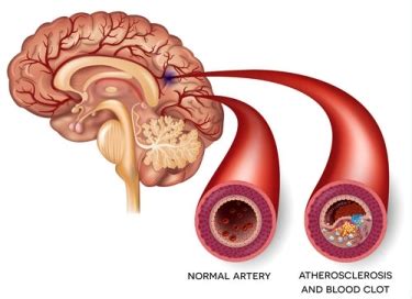 Ischemic stroke explained