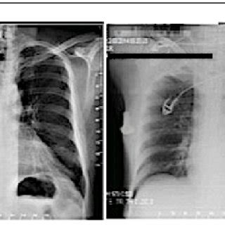 Concurrent Posterior Anterior Chest Radiography Showing Decreased