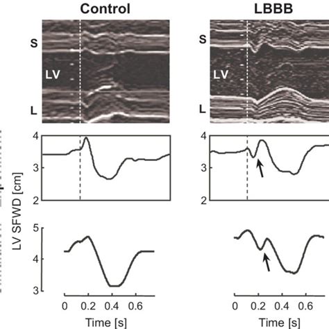 Time Courses Of Left Lv And Right Rv Ventricular Hemodynamics As