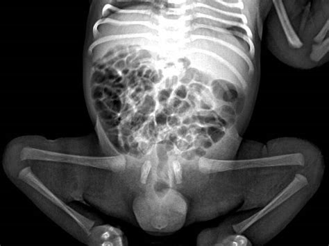 Caudal Regression Syndrome Radiology