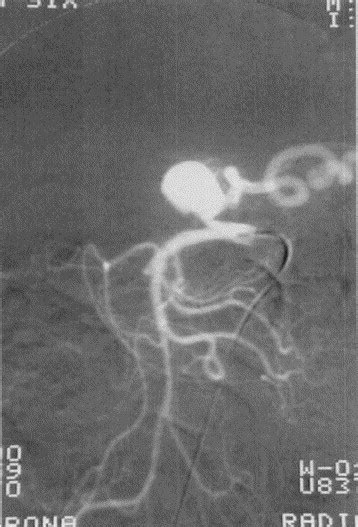 Managing Anomalous Splenic Artery Aneurysm A Review Of The Literature And Report Of Two Cases