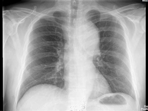 Aortic Dissection On Chest X Ray