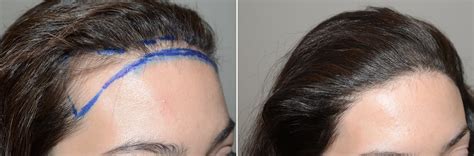 Forehead Reduction Surgery Hair Transplants For Women Photos Miami