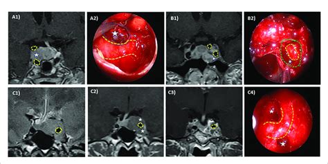 Intraoperative Radiologic Correlation Of Cavernous Sinus Invasion In