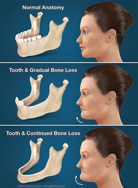 Dangers Of Missing Teeth Ottawa Il