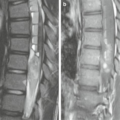 Mr Imaging Features Of The Tumor Sagittal T2 Weighted A And