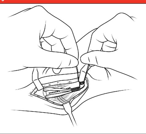 Figure 1 From Comparison Of Surgical Techniques For Ulnar Collateral Ligament Reconstruction In