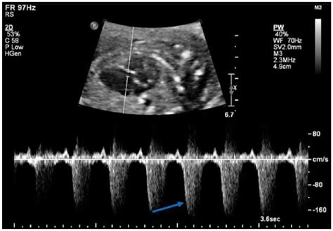 Prenatal Sonographic Detection Of Ebsteins Anomaly Mariah C Root