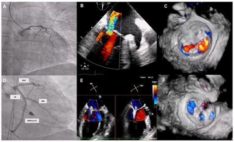 Combined Use Of MITRACLIP And Ventricular ASSIST Devices In Cardiogenic