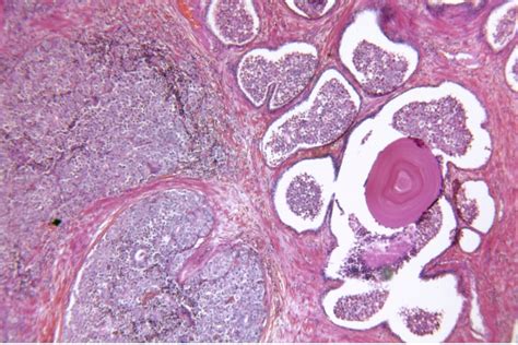 Epitelio Glandular Convive Con El Cáncer