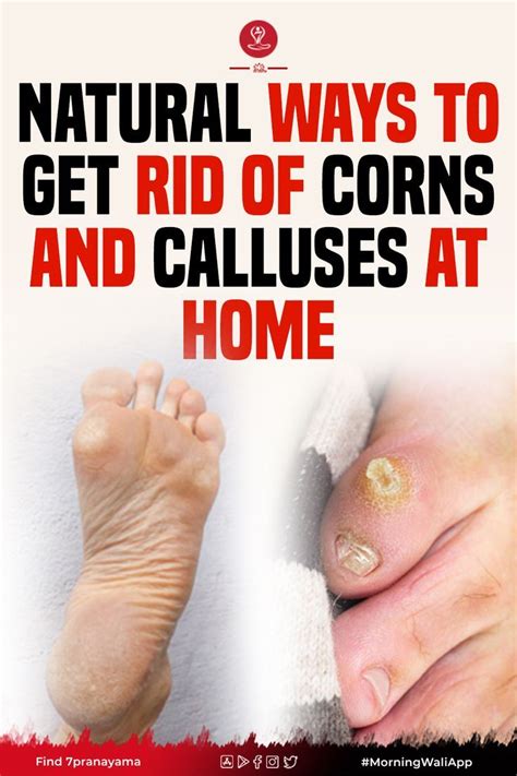 Natural Ways To Remove Corns And Calluses At Home