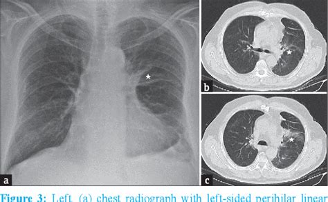 Figure 1 From Linear Atelectasis Around The Hilum On Chest Radiography