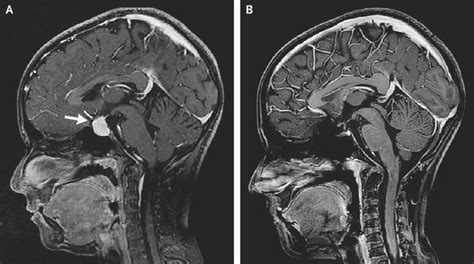 Pituitary Hyperplasia From Primary Hypothyroidism Medizzy