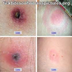 Normal Tick Bite Pictures