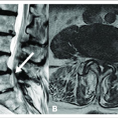 Sagittal A And Axial B Lumbar Spine Magnetic Resonance Imaging For