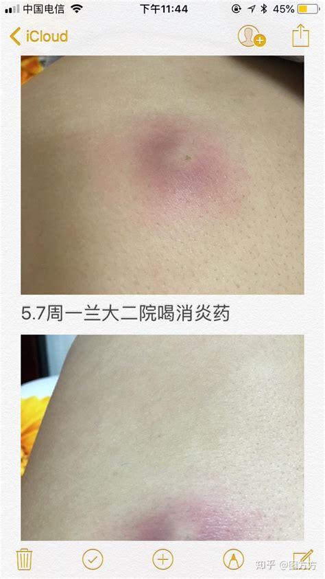 原来我长的不是疖子而是皮脂腺囊肿又称粉瘤 知乎