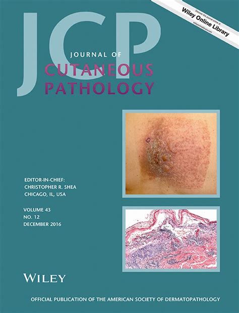 Cutaneous Nodular Fasciitis With Genetic Analysis A Case Series