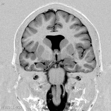 Septo Optic Dysplasia Radiology Reference Article Radiopaedia Org