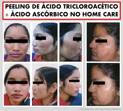 Peeling De Cido Tricloroac Tico Cido Asc Rbico Home Care No