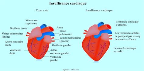 Tout Savoir Sur L Insuffisance Cardiaque