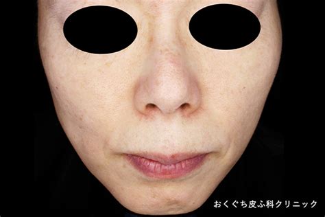 ソバカス 南仙台の皮膚科・美容皮膚科｜シミ治療・医療脱毛｜おくぐち皮ふ科クリニック