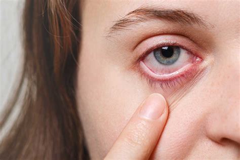 Herpes Ocular Descubren Una Prote Na Clave En Las Reinfecciones