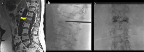 Vertebroplasty Radiology At St Vincent S University Hospital