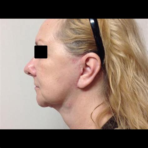 Resultado Lifting Facial Bivella