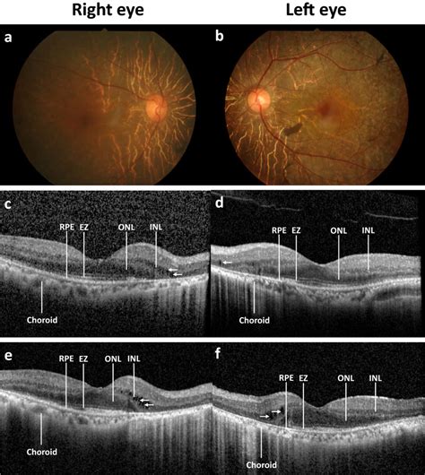 Disease progression of a patient with autoimmune retinopathy (AIR ...