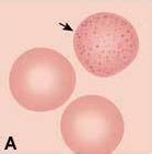 FICHERO DE HEMATOLOGÍA ANORMALIDADES ERITROCITARIAS Anormalidades de