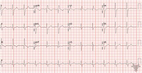 Bifascicular Block Ecg Stampede