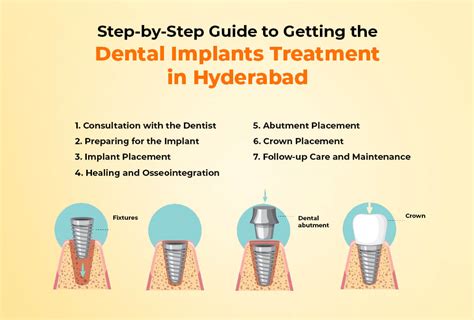 Step By Step Guide To The Dental Implant Procedure