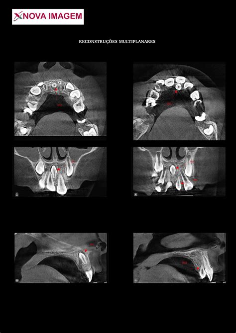 Tomografia Computadorizada Cone Beam Nova Imagem RX