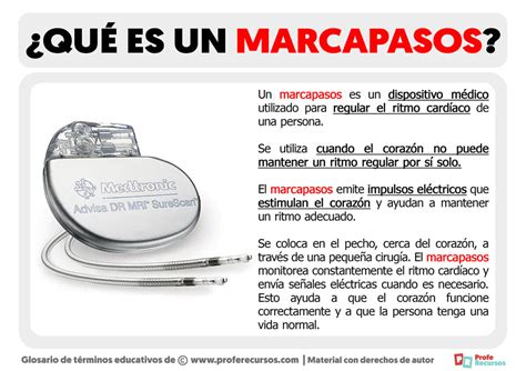 Qué es un Marcapasos Definición de Marcapasos