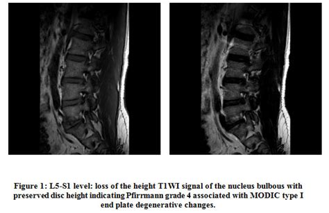 Spinal Degeneration And Degenerative Disc Disease Correlation Identified With Magnetic Resonance